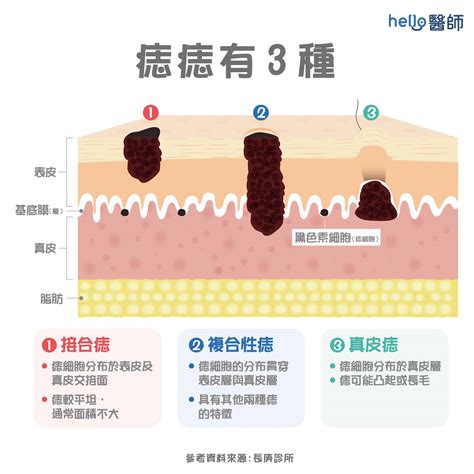 身上的痣|為什麼臉上的痣越來越多？皮膚科醫師解析長痣原因、。